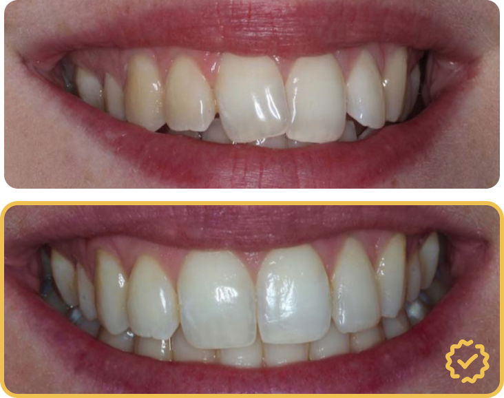 Clear Aligners Before After Comparison